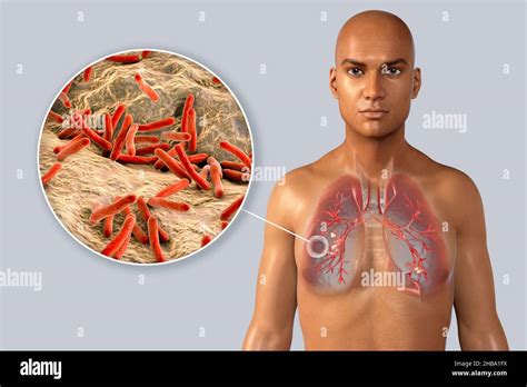 Ilustraci N De La Tuberculosis Pulmonar Fibrosa Cavernosa Con Una