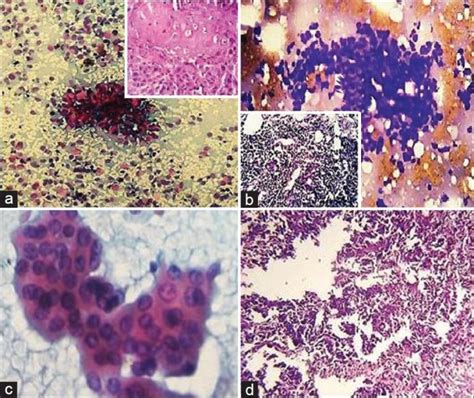 A Squamous Cell Carcinoma Cytologic Smear Showing Malignant Squamous