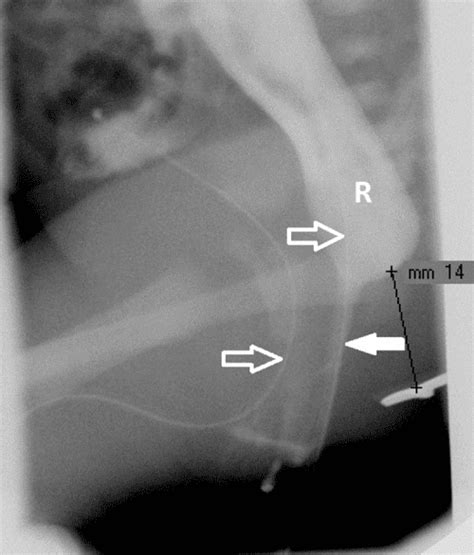 Figure From Usefulness Of Transperineal Ultrasonography Tpus In