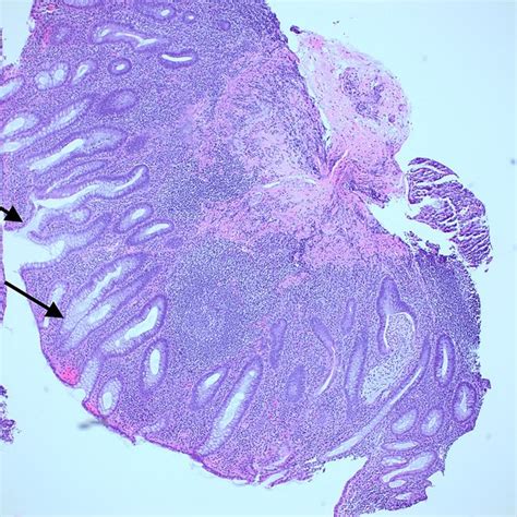 Left Colon Biopsy From 2019 This Is A Hematoxyloin And Eosin Stain Download Scientific Diagram