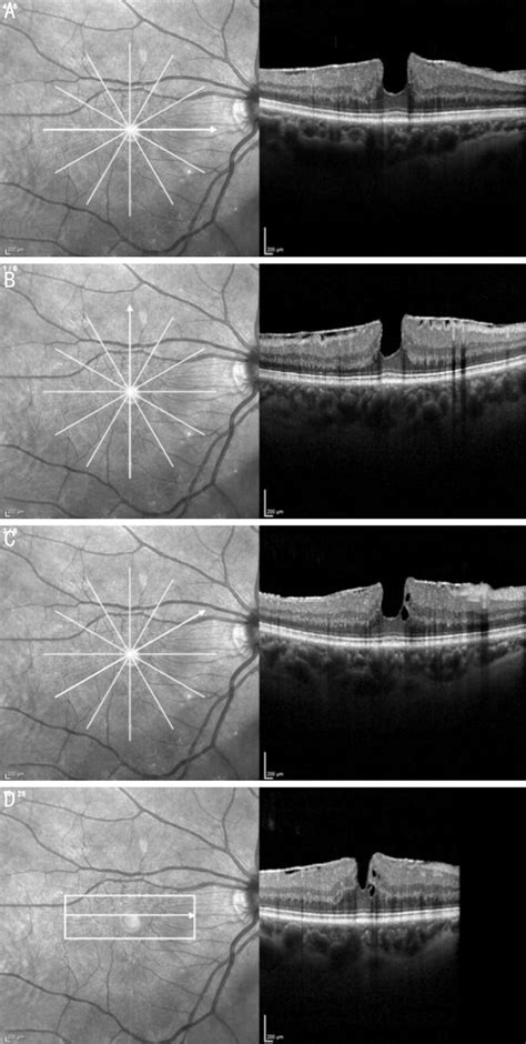 Oct Examination Of The Right Eye The Radial Scan Is Wellcentered The