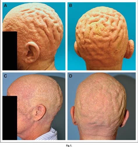 Cutis Verticis Gyrata In Association With Vemurafenib And Whole Brain