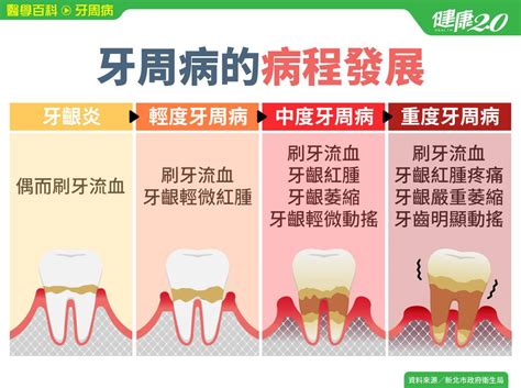 怎麼知道自己牙周病？ 明日淼富