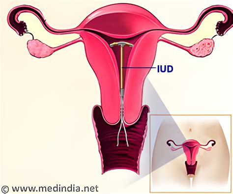 Are Hormonal Iuds Effective In Emergency Contraception