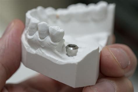 3 Dental Implants That Can Restore Your Perfect Smile Keep Asking