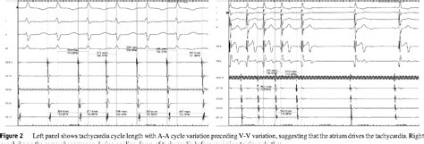 Figure From Para Hisian Atrial Tachycardia Ablation In A Patient With