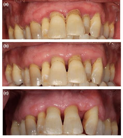 Early Periodontitis Home Treatment