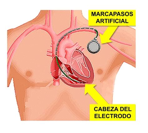 Qué tienen en común los marcapasos y los reactores nucleares