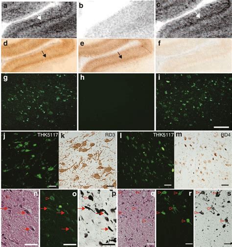 Analysis Of Binding Targets Of THK 5117 In Post Mortem AD Brain