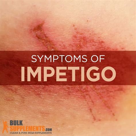 Impetigo: Symptoms, Causes & Treatment