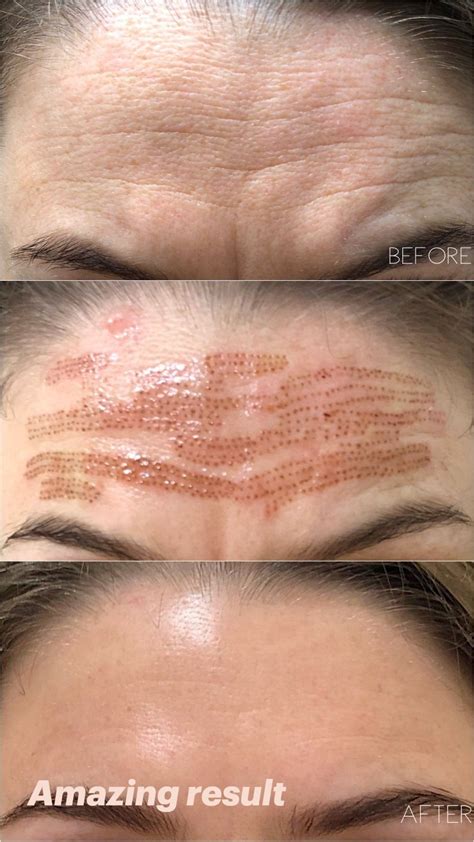 Fibroblast Plasma Pen Skin Tightening Maquillage Permanent Levres