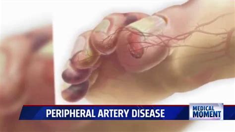 Symptoms And Treatments For Peripheral Artery Disease Pad Youtube