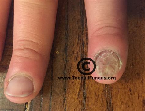 Long fingers, infected – Toenail Fungus