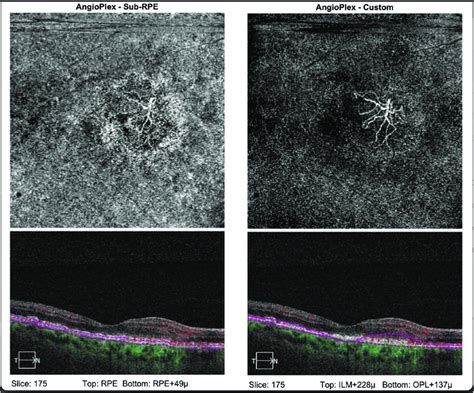 A Showing Octa And Structural Oct From An Eye With Inactive Cnvm