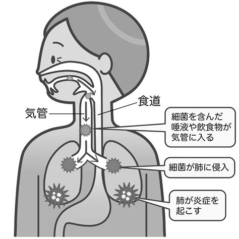 誤嚥性肺炎のイラスト🎨【フリー素材】｜看護roo [カンゴルー]