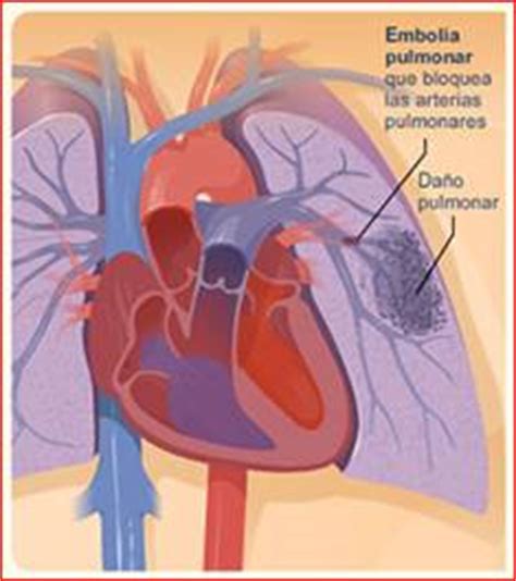 Endocarditis Infecciosa Una Amenaza Latente Alipso Monograf As