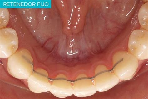El Retenedor De Ortodoncia Su Importancia Tras El Tratamiento