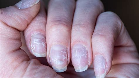 Why Are My Gel Nails Peeling Understanding The Causes And Solutions