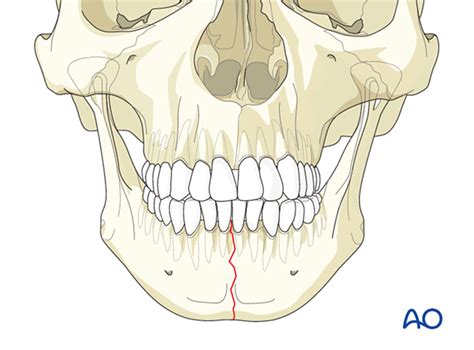 observation adults  symphysis  parasymphysis simple