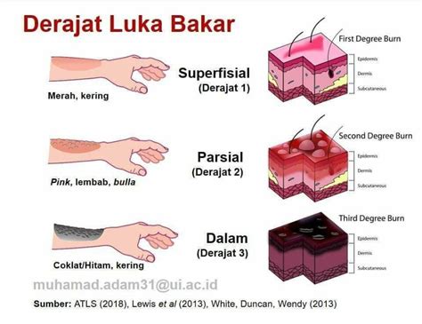 Tepat Tangani Luka Bakar Sesuai Tingkatannya Merahputih