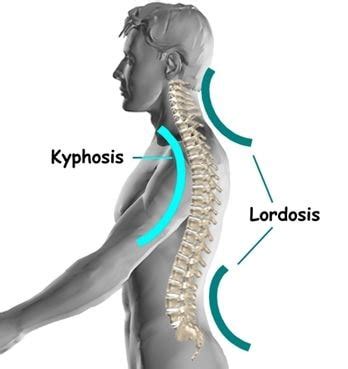 Lumbar Lordosis - Exercises, How to Fix, Treatment, What is