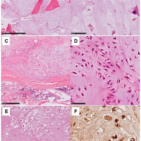 Dedifferentiated Chondrosarcoma 200× A Well Differentiated Download Scientific Diagram