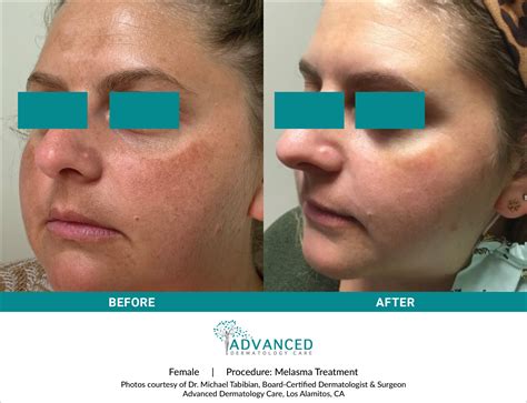 Melasma Treatment Advanced Dermatology Care