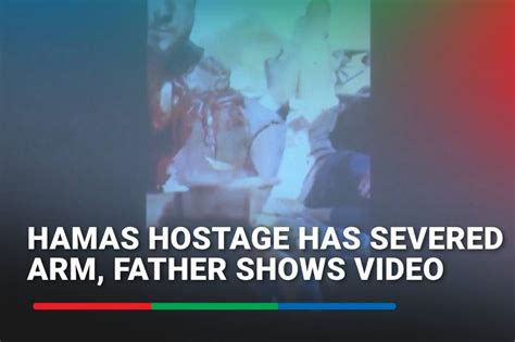 Hamas Hostage Has Severed Arm Father Shows Video Abs Cbn News