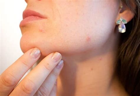 Remove Acne Scars Sydney 1 Where To And How Safe Effective