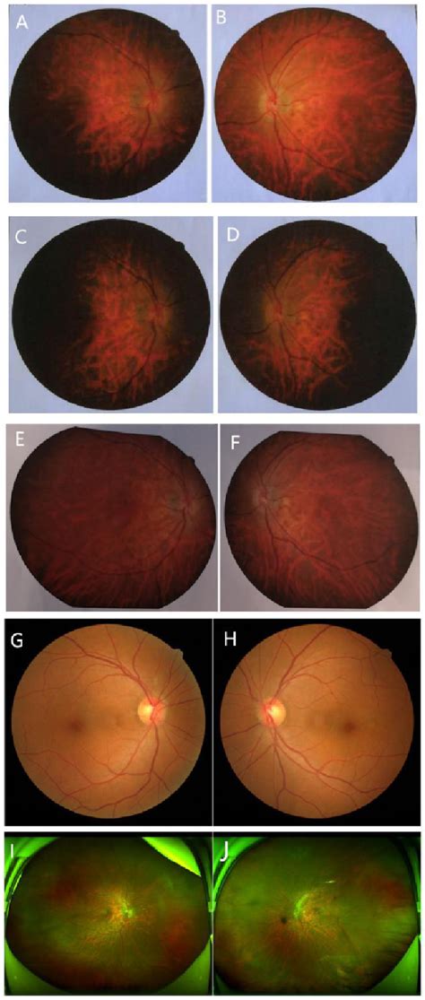 Bilateral Full Thickness Macular Hole Formation After Single Dose Of