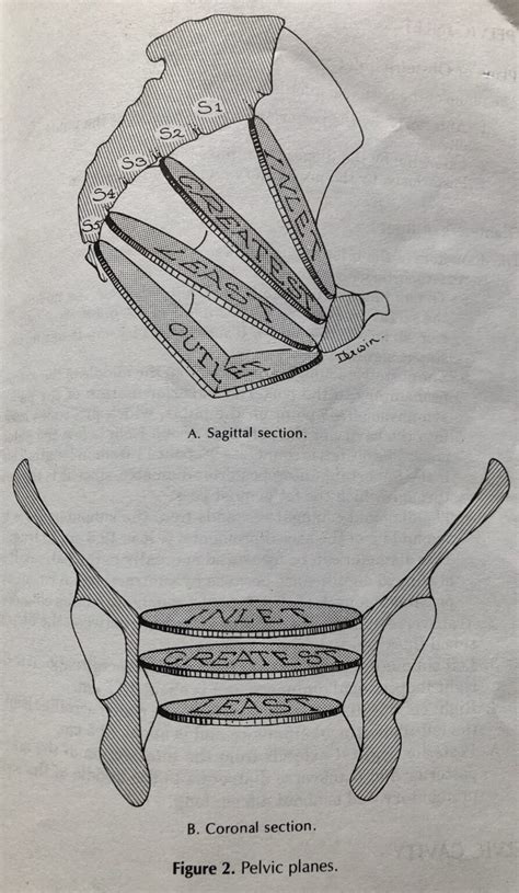 OPTIMIZING LABOR POSITIONS WITH AN EPIDURAL