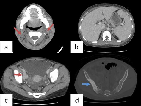 Computed Tomography Before Treatment A Cervical Download Scientific Diagram