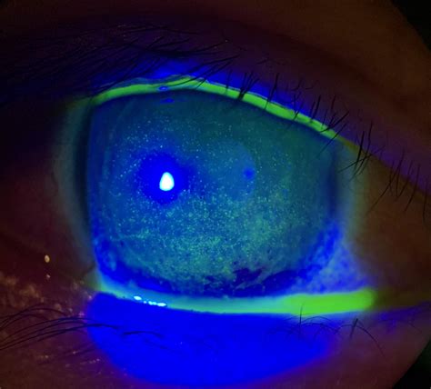 Corneal Keratitis R Optometry