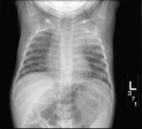 Figure From Tuberculosis Tb Disease Classification And Initial