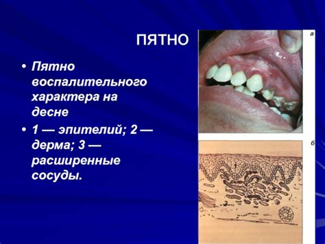Строение кожи и слизистых. Кандидоз