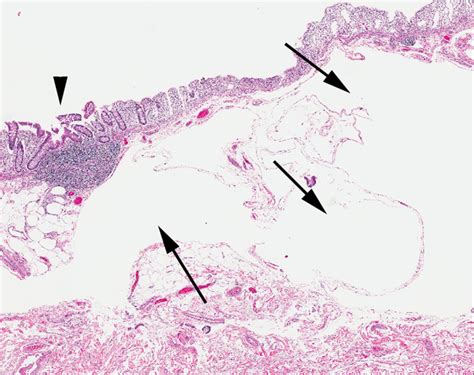 Recurrent Pneumatosis Intestinalis In A Patient With Dermatomyositis Bmj Case Reports