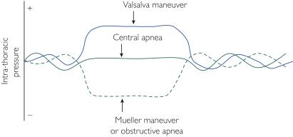 Sleep Apnea, Septal Myectomy, and the Valsalva/Mueller Maneuvers: Who ...