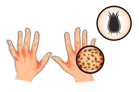 What Does A Scabies Mite Bite Look Like Diseasefix