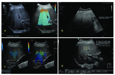 Images of liver steatosis quantified using different ultrasound-based ...