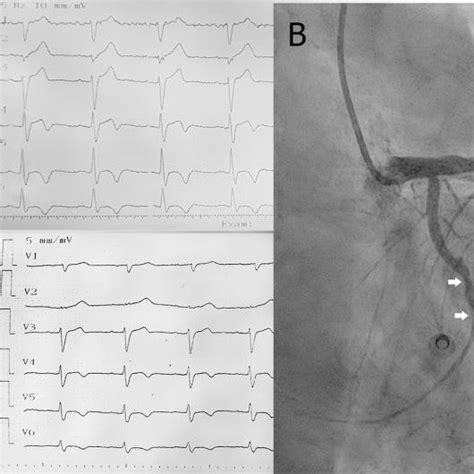 (A) Admission ECG showing sinus rhythm, 0.2 mV ST-segment elevation in ...