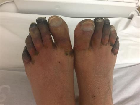 Figure 1 From Symmetrical Peripheral Gangrene Associated With Low