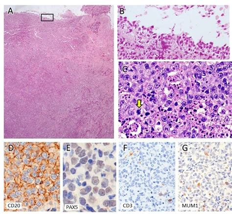 Histopathological A C HE Staining And Immunostaining D G Findings