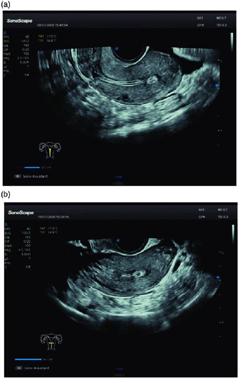 A And B Three Dimensional Transvaginal Ultrasonographic Images Of