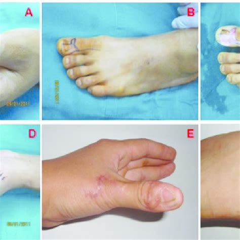 The Patient In Case 1 A Preoperative View Of Soft Tissue Defect Of