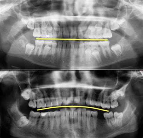 Panoramic Radiography Flashcards Quizlet