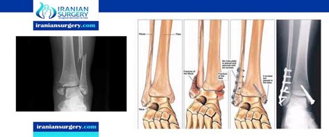 Bimalleolar And Trimalleolar Ankle Fractures Iranian Surgery