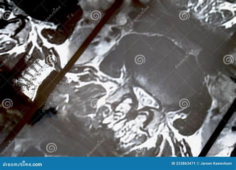 Chest X Ray Film Of A Cardiomegaly Female Patient Stock Image Image