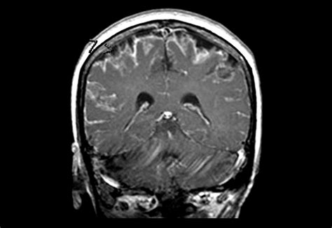 Bacterial Meningitis Brain Mri