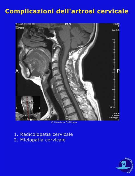 Artrosi Cervicale I Sintomi Reali E La Terapia Pi Efficace