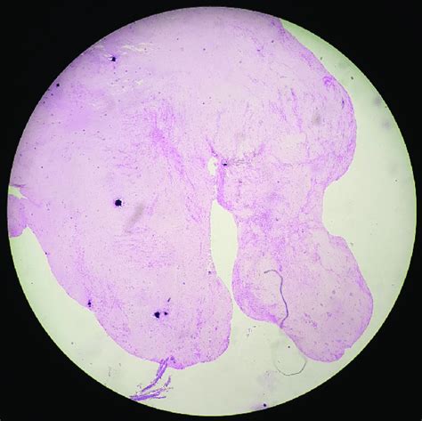 Histopathology of the extruded disc. | Download Scientific Diagram